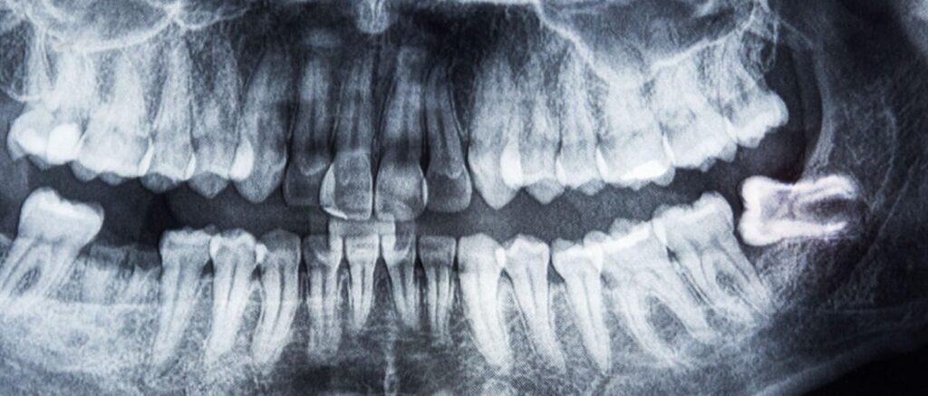 Las muelas del juicio todo lo que necesitas saber Clínica Dental Plaza