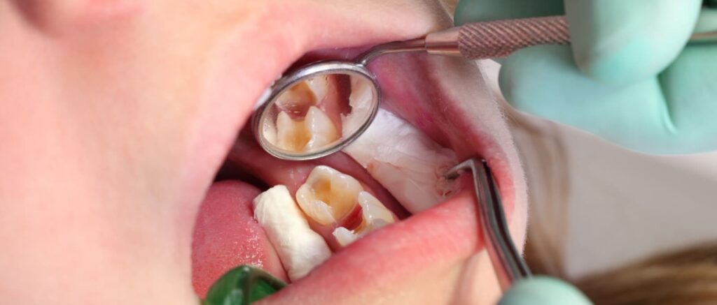 Prevenir caries dentales