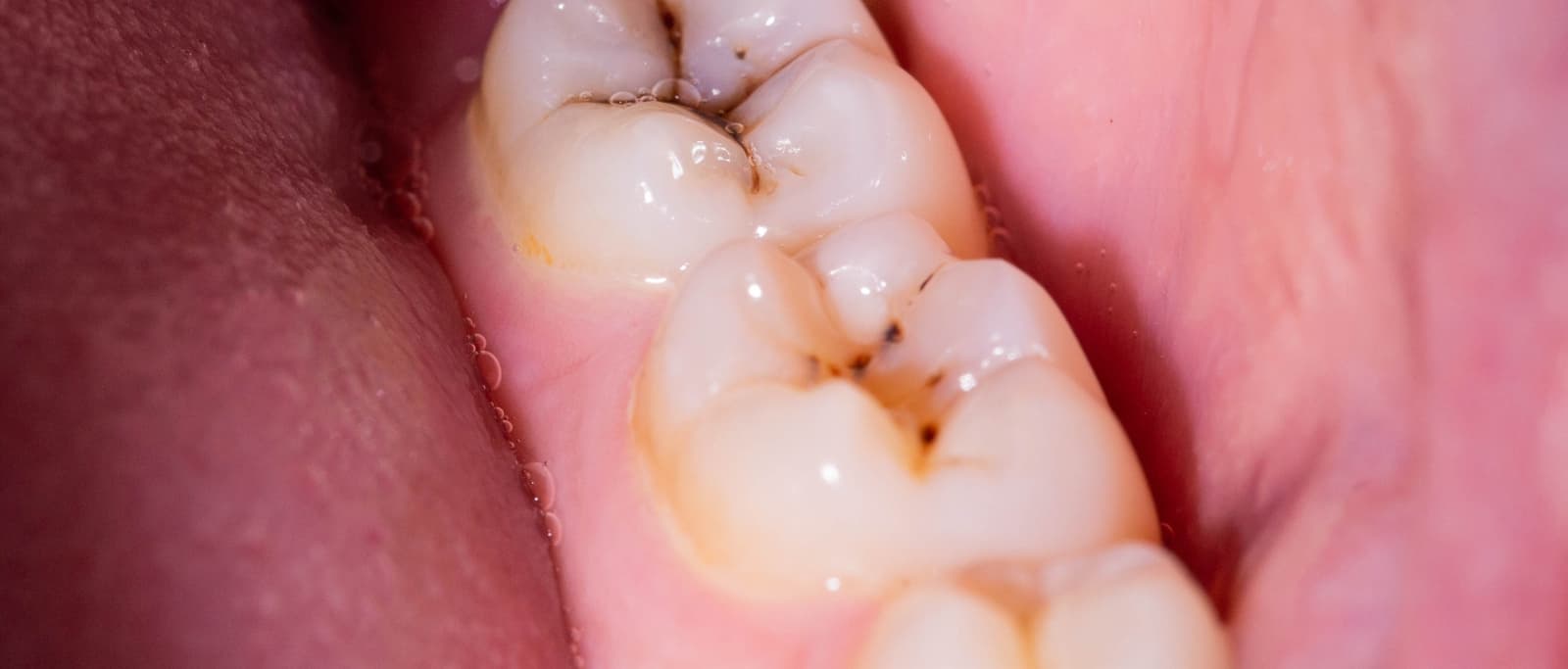 Prevenir caries dentales en las muelas