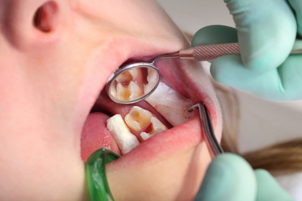 Cómo prevenir las caries dentales