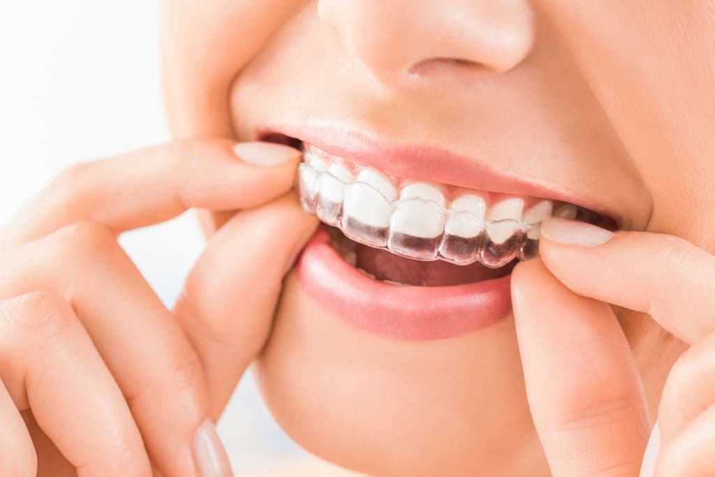 ¿Qué son los retenedores dentales?