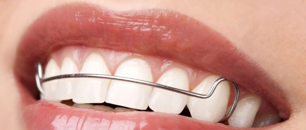 retenedores dentales metálicos