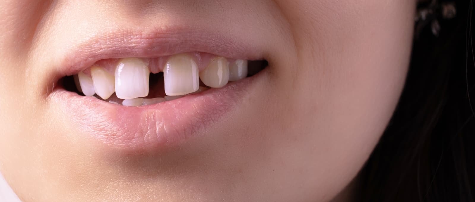 diastema